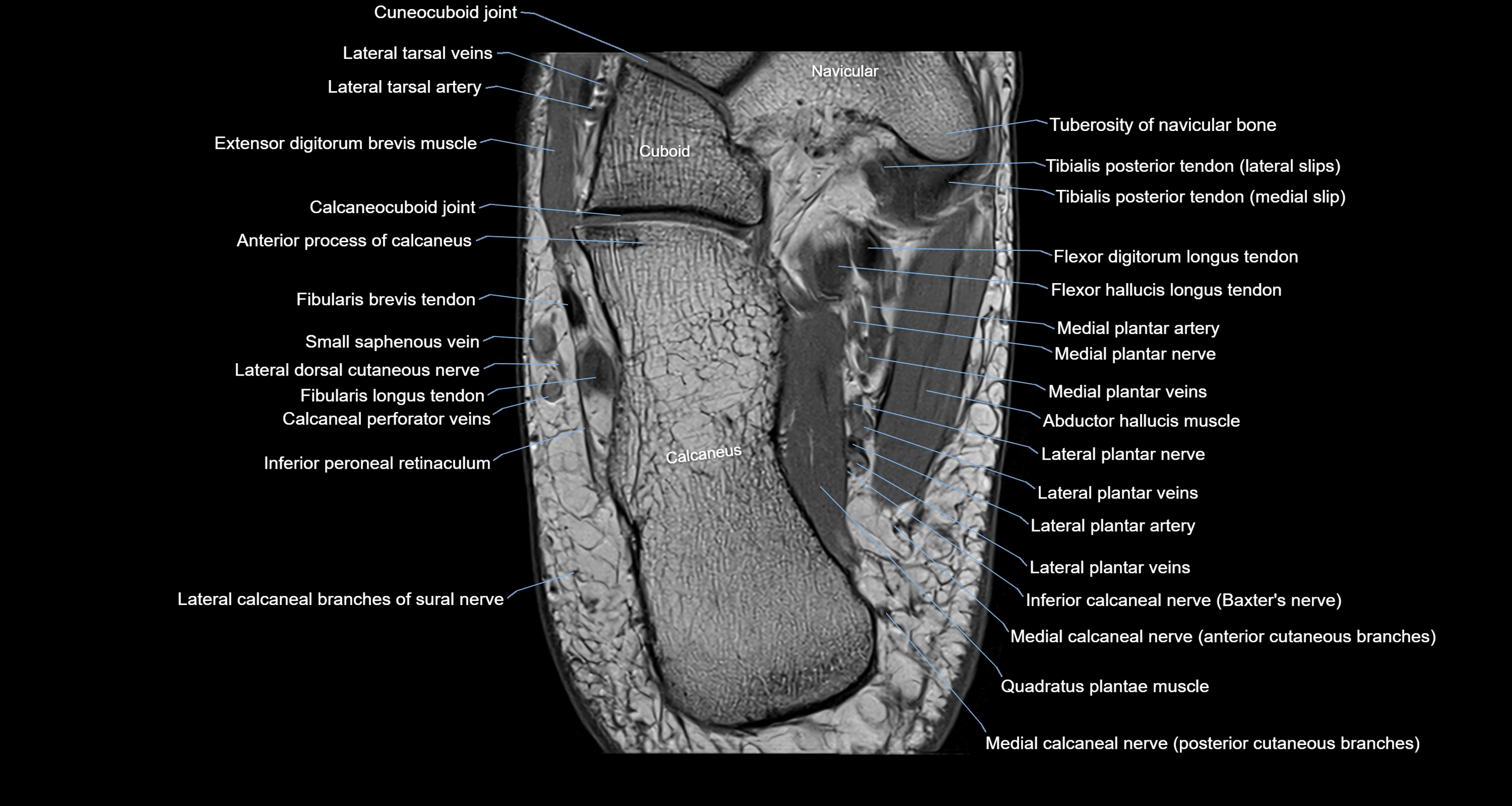 Ankle axial anatomy 3T MRI images -img-10001-00031.webp